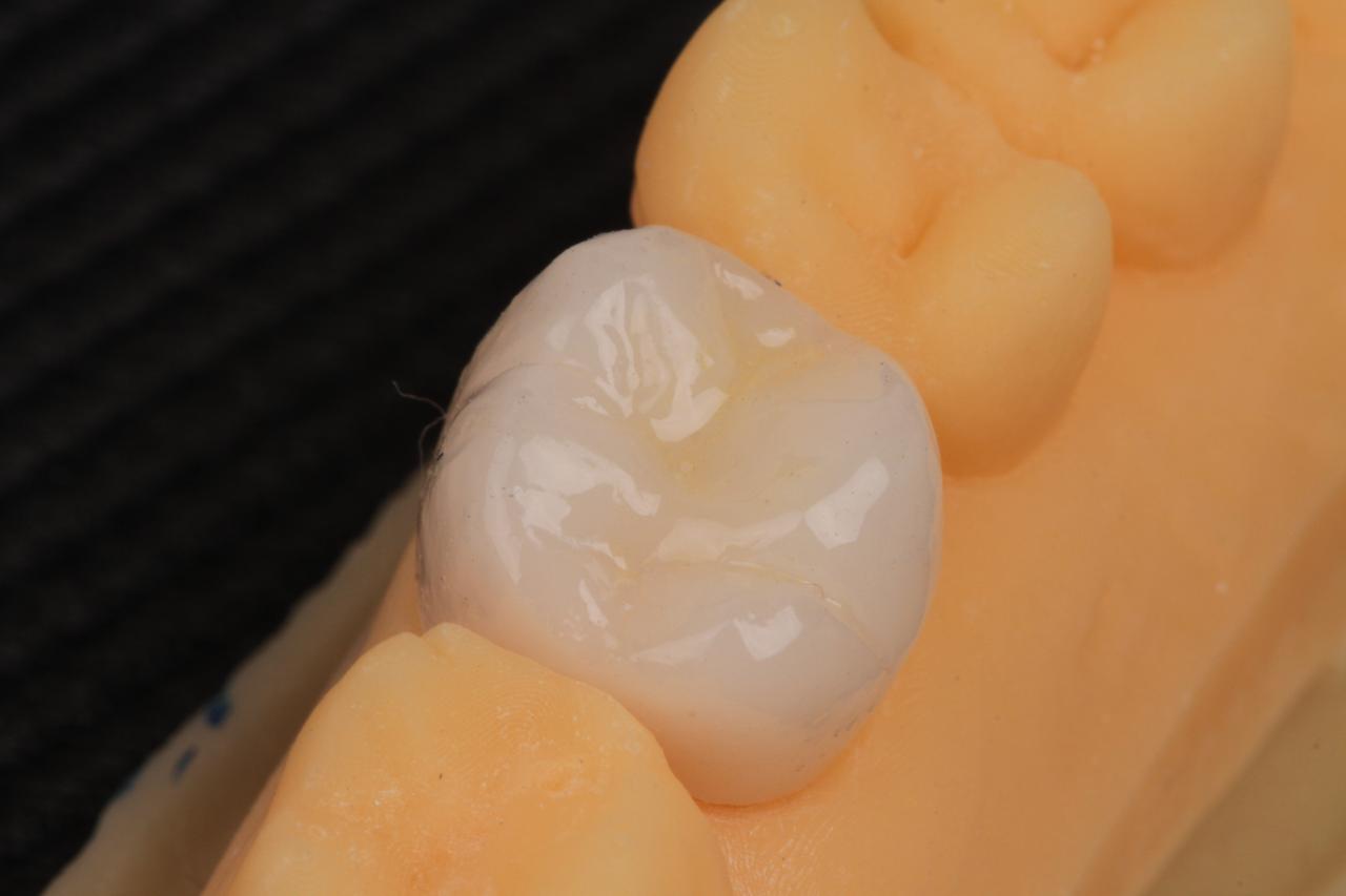 Coroa dentária clara posicionada sobre modelo odontológico