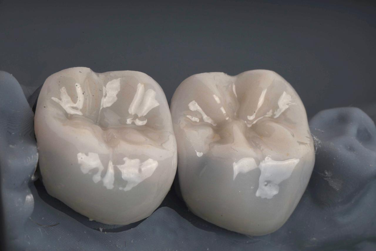 Duas coroas dentárias claras apoiadas em modelo cinza