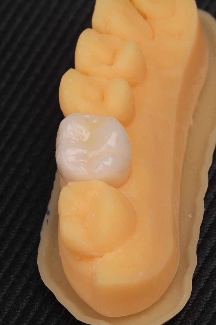 Coroa dentária clara encaixada em modelo odontológico