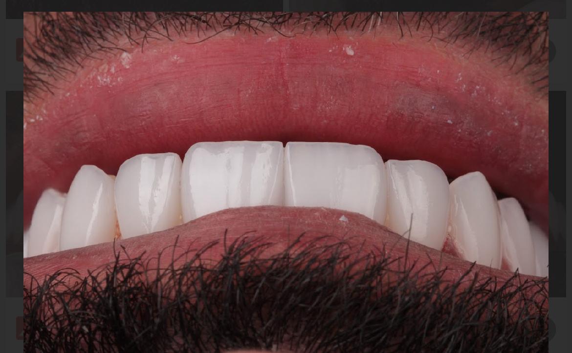 Vista frontal de dentes anteriores e sorriso