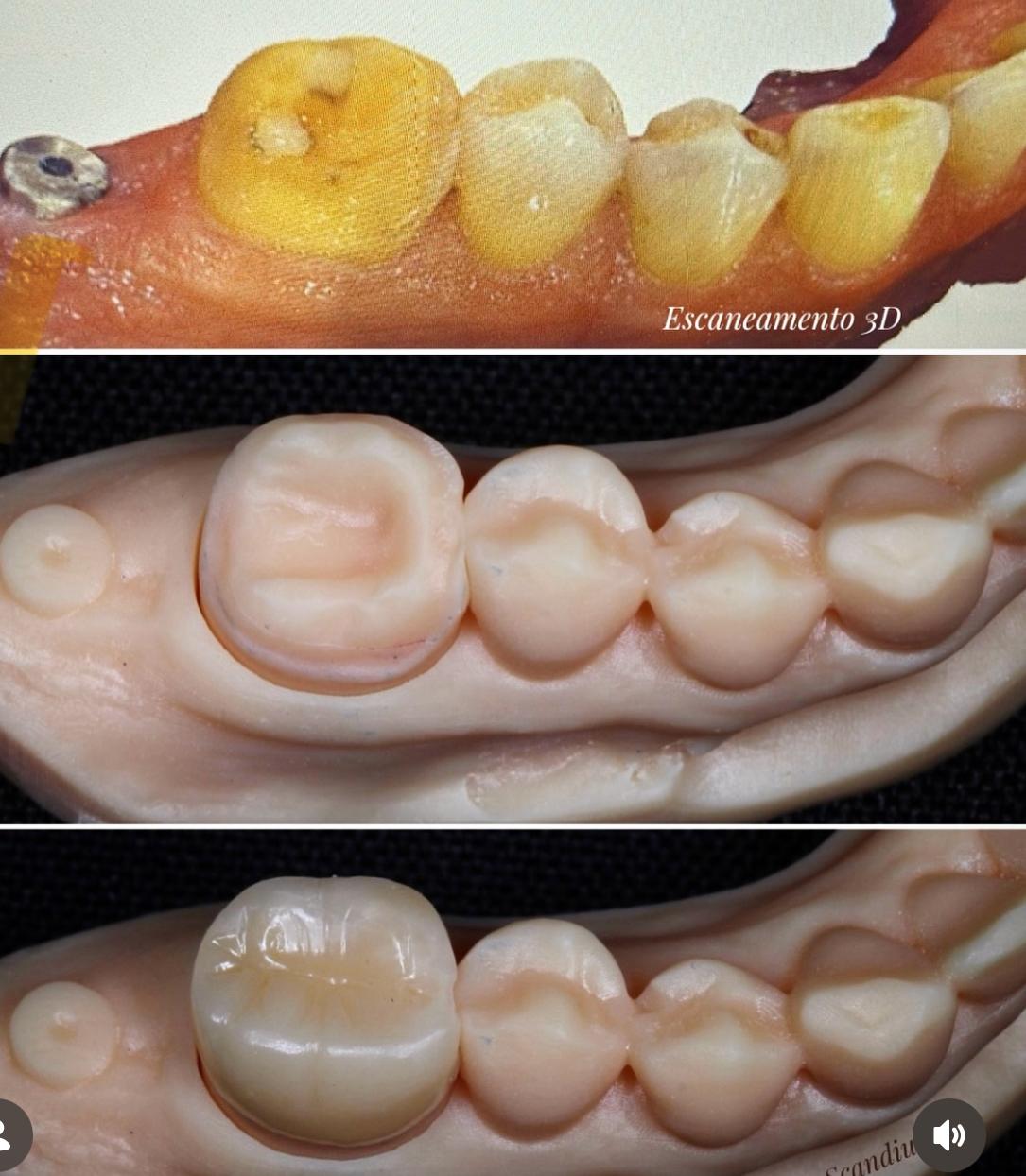 Sequência fotográfica de modelo odontológico e coroa finalizada